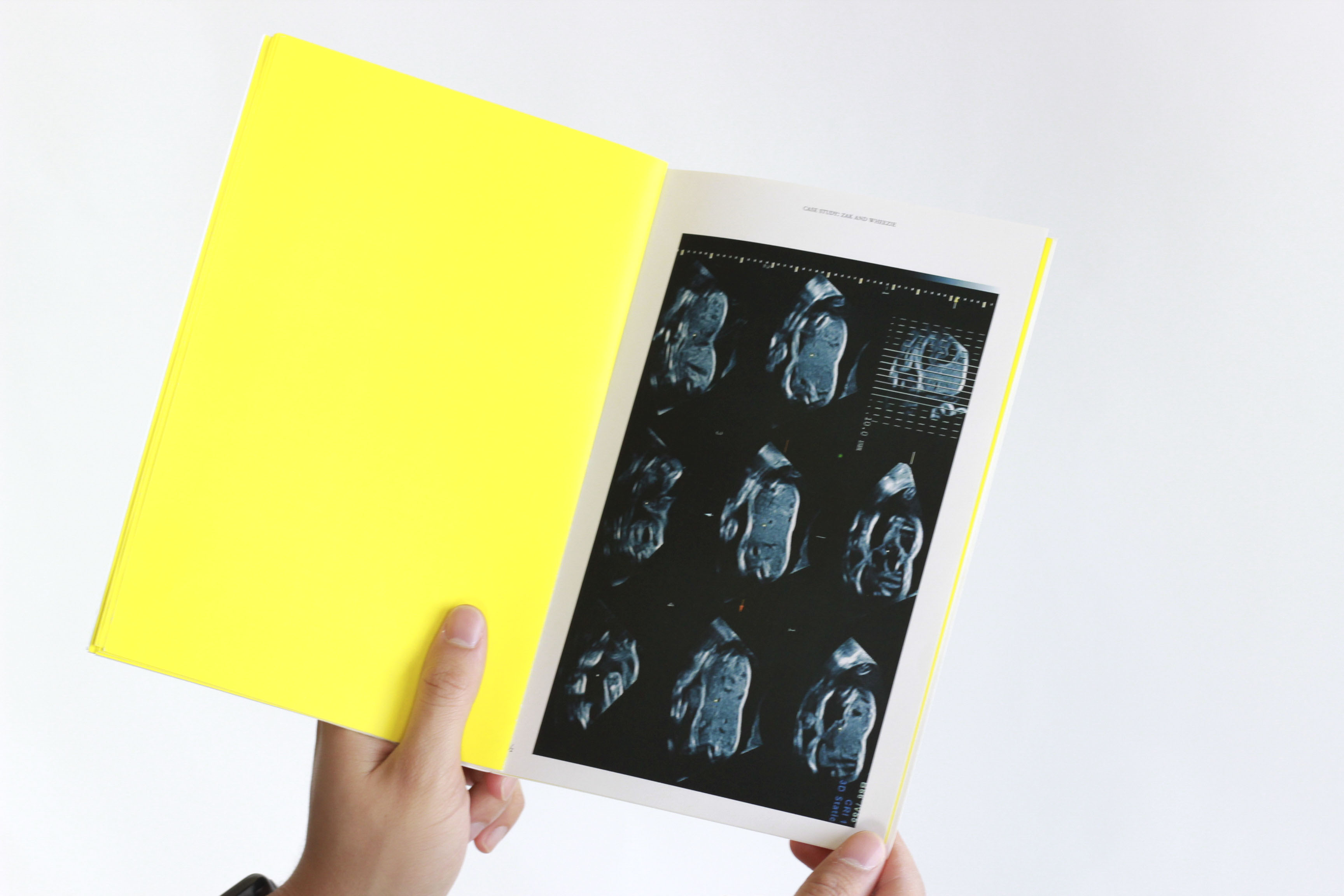 Conjoined Twins and the Animated World