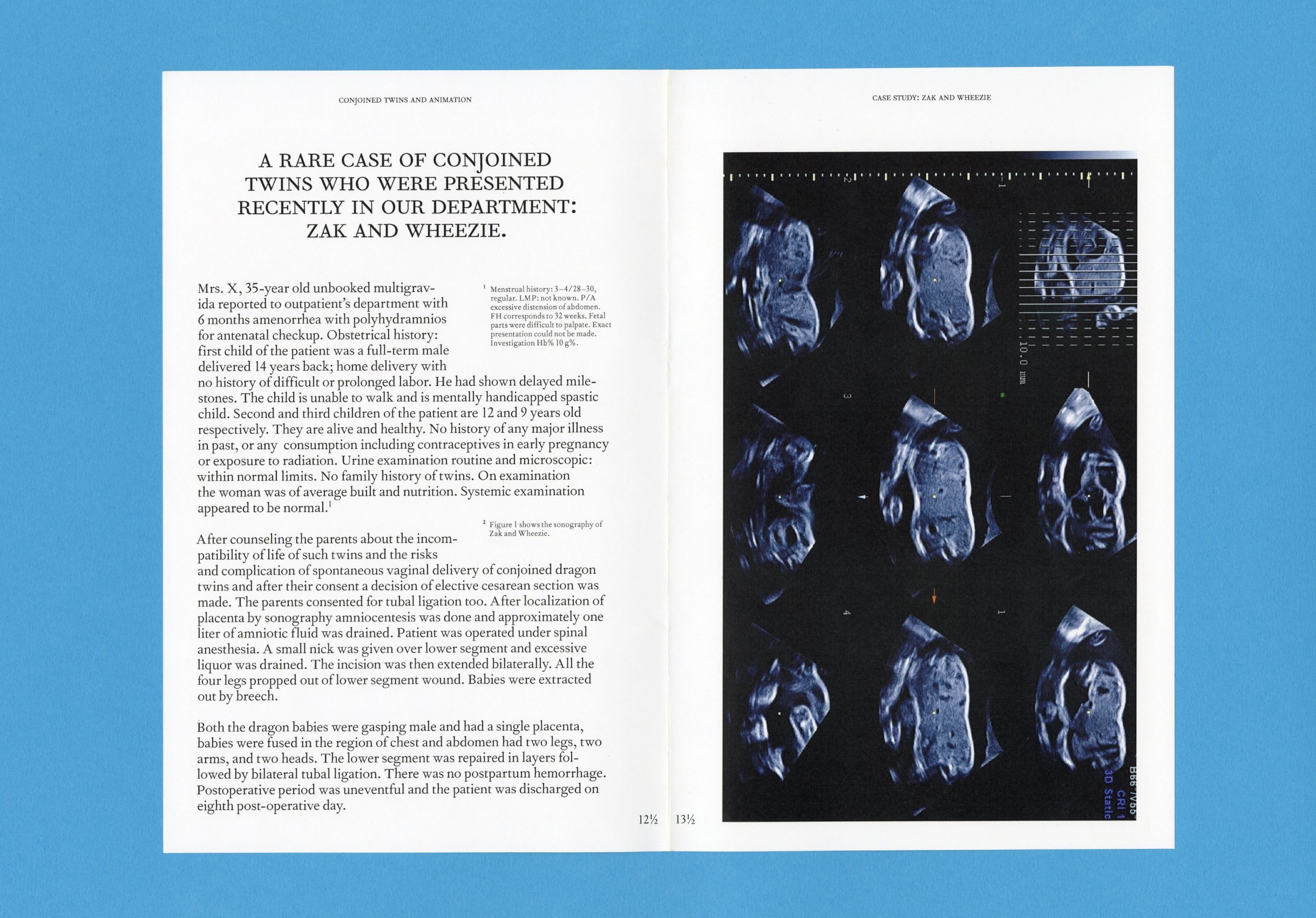 Conjoined Twins and the Animated World